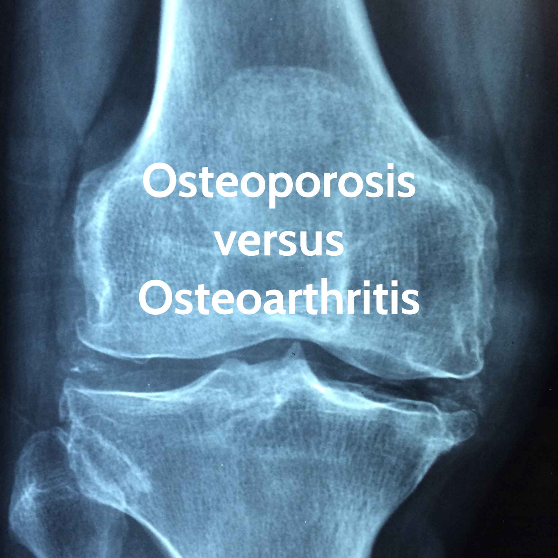 Osteoporosis versus Osteoarthritis - Compassion Primary Care