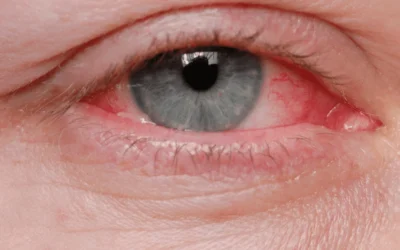 Conjunctivitis: Symptoms, Causes, and When to Seek Care