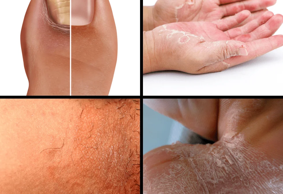 fungal infections